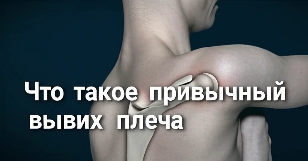    Что такое привычный вывих плеча Гиппократ Бальзамов