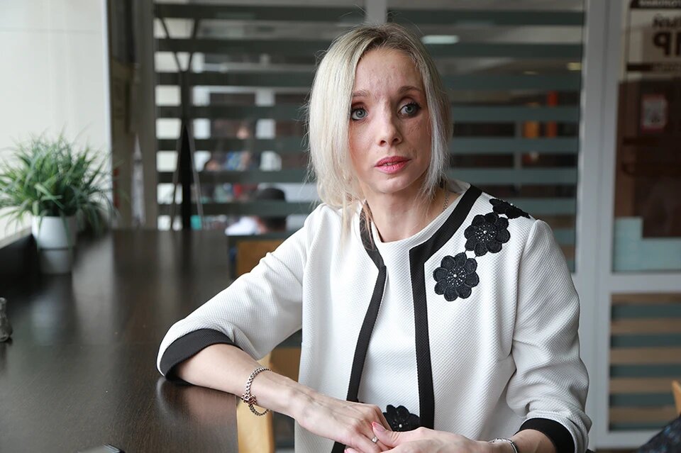 Красноярские врачи вернули девушке лицо, которое она потеряла 10 лет назад в страшной аварии. Фото: Мария ЛЕНЦ. 