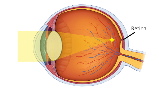Фокус изобрадения при миопии лежит перед сечаткой