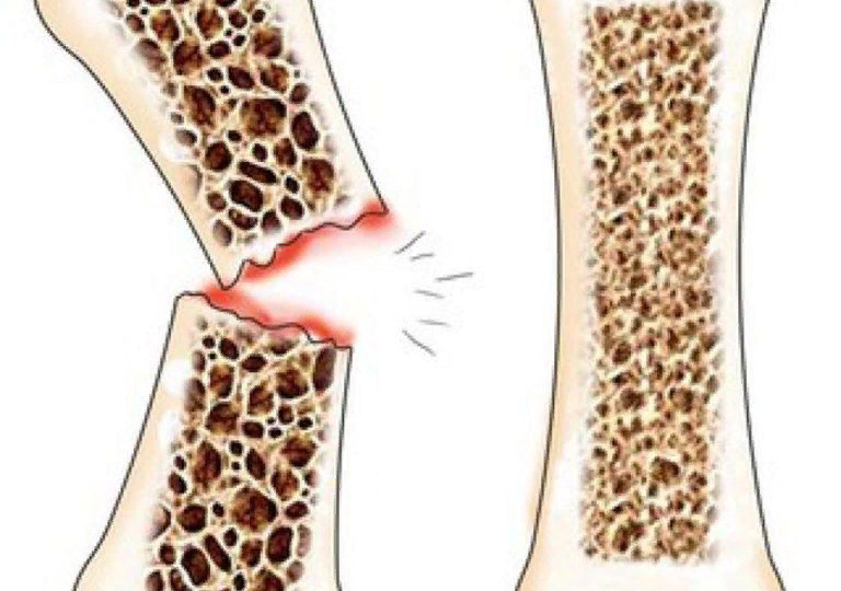 Как укрепить кости при метастазах: остеомодифицирующие препараты