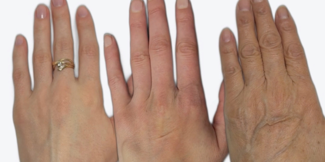 Как определить свой уровень коллагена?