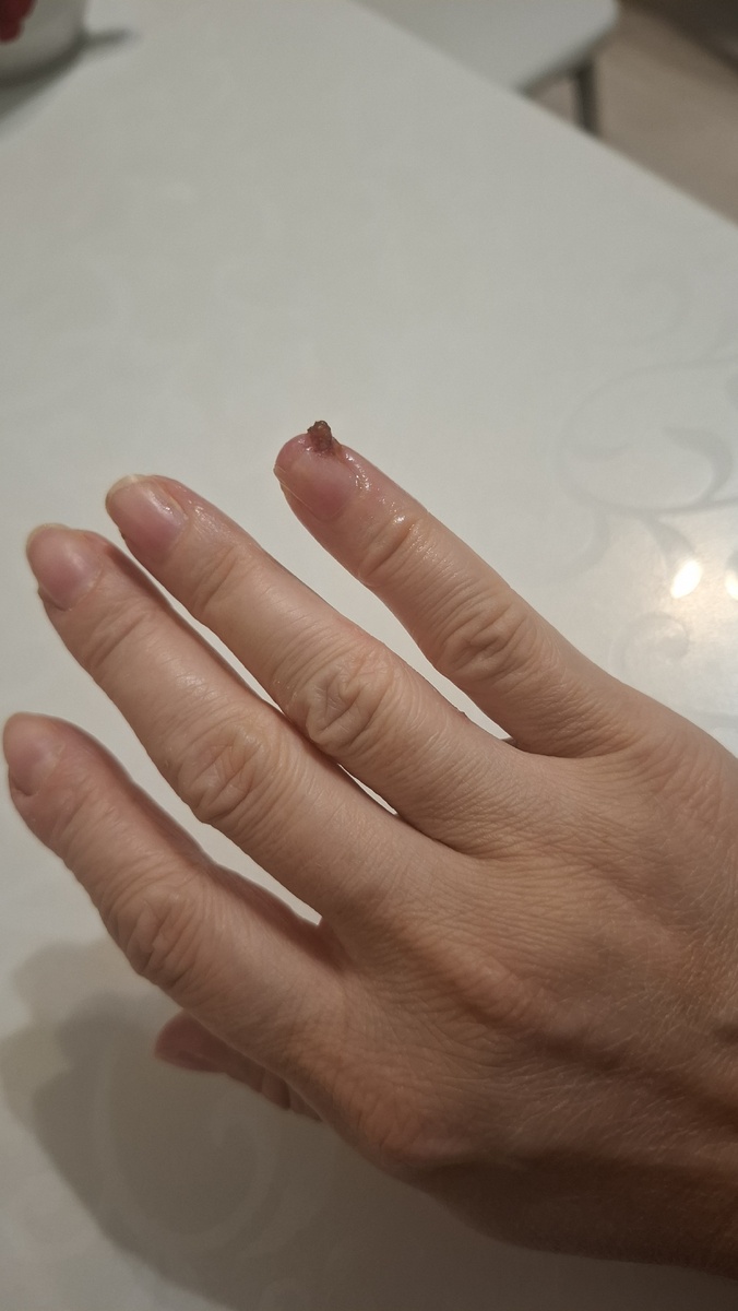 Вот такая болячка образовалась