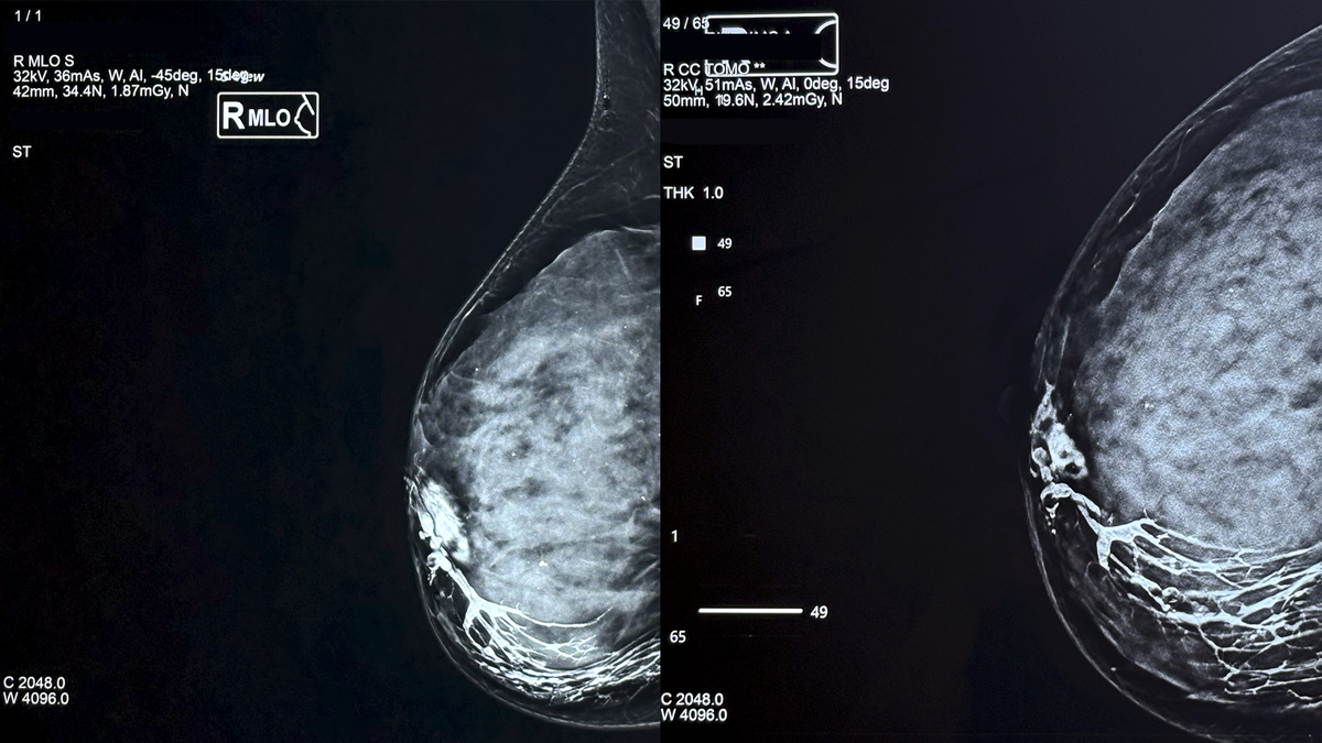 "ампутация" протока в нижне-наружном квадранте правой молочной железы патологическим образованием