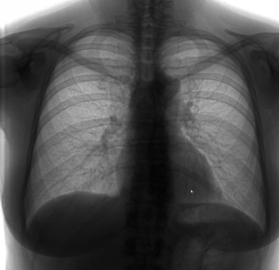   Так выглядят легкие здорового человека. Фото из личного архива.