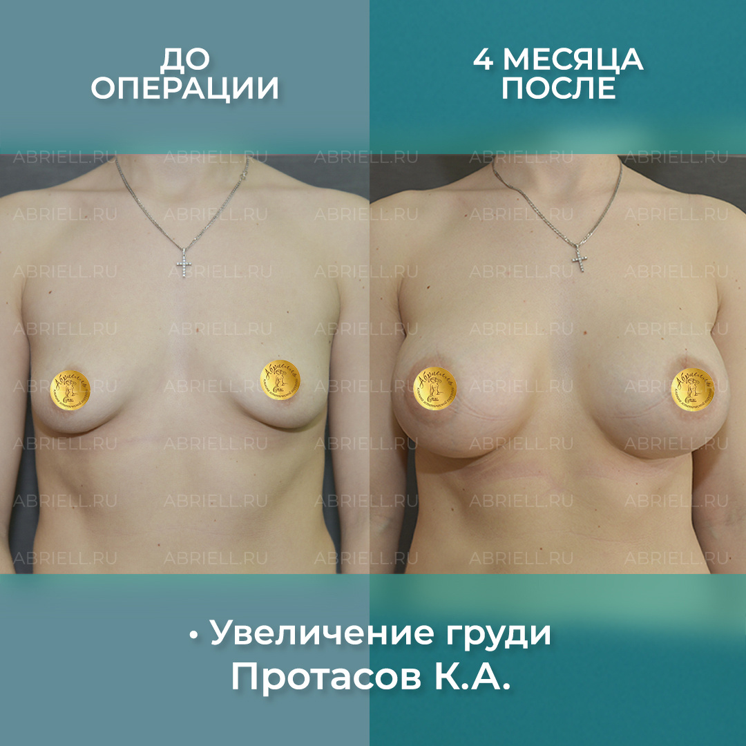 Пластический хирург в Санкт-Петербурге Протасов Кирилл Андреевич / Маммопластика - увеличение груди силиконовыми имплантами 