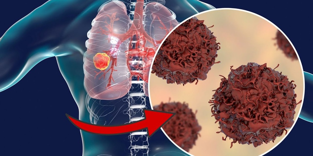 История пациента: рак нашли только на третьем обследовании