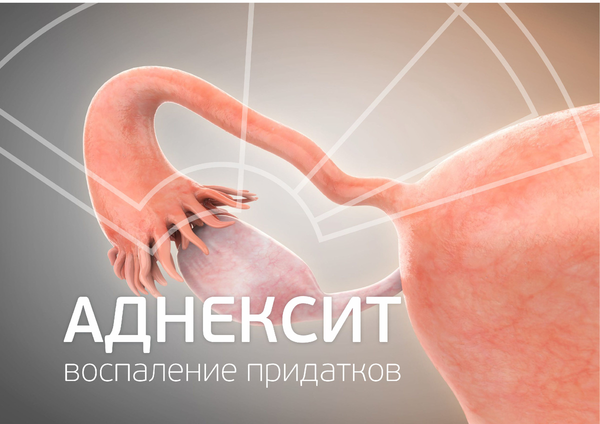 Аднексит. Как распознать воспаление придатков на ранней стадии