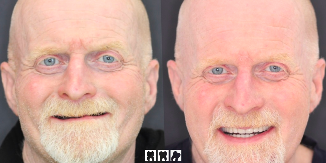 Полное восстановление зубного ряда без седации по методике ALL-on-4. Как это было?