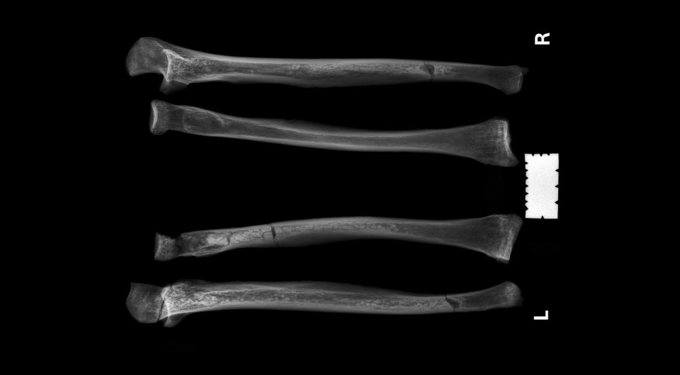   Satu Valoriani et al. / International Journal of Paleopathology, 2025