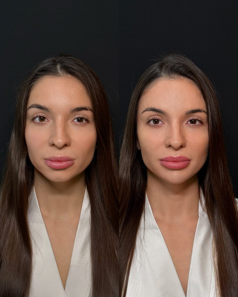 до/после контурной пластики губ