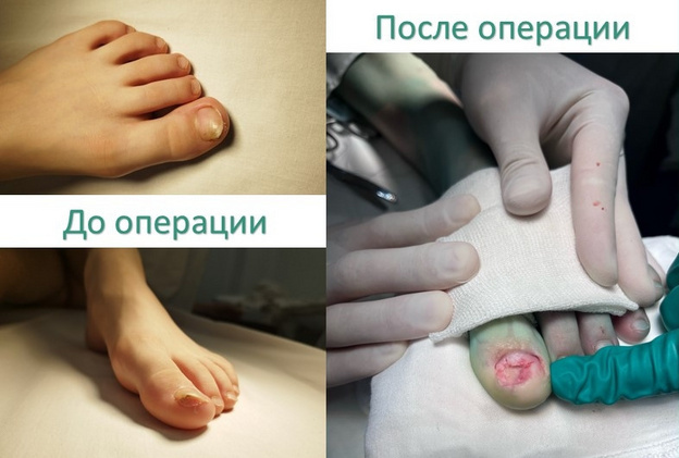    Травматолог предупредила о костной опухоли, которую путают с вросшим ногтем