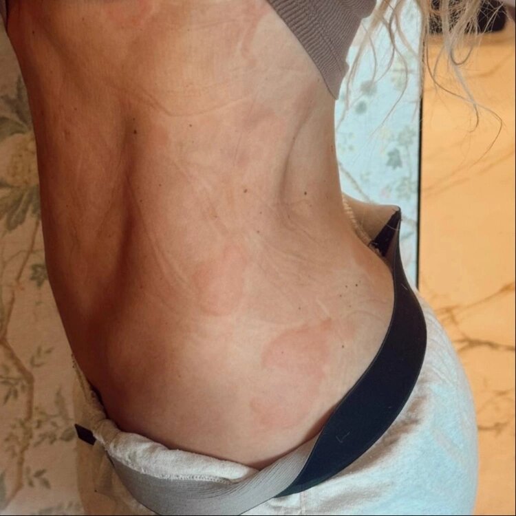 Анна Седокова показала последствия болезни на фото📷
