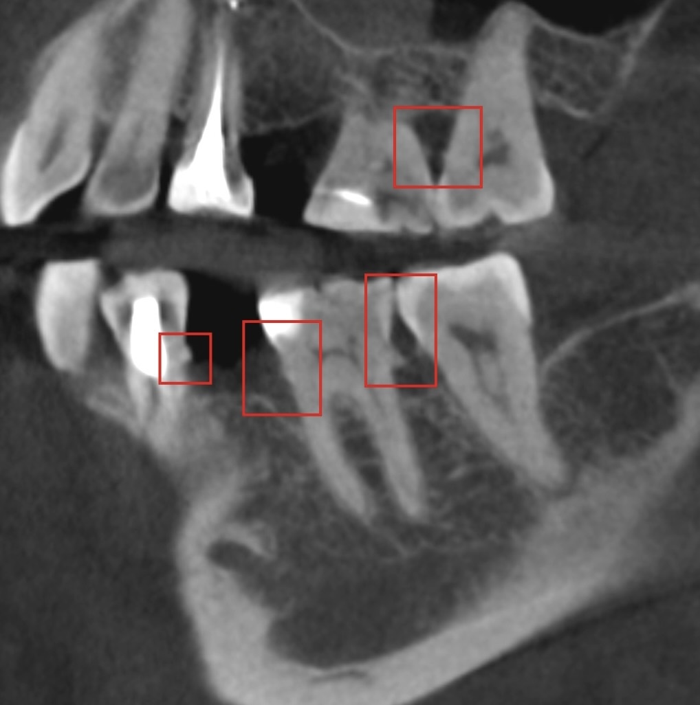 Поддесневые зубные отложения