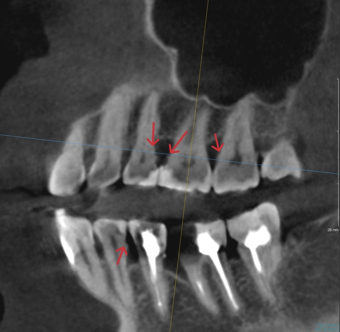 Поддесневые зубные отлоения