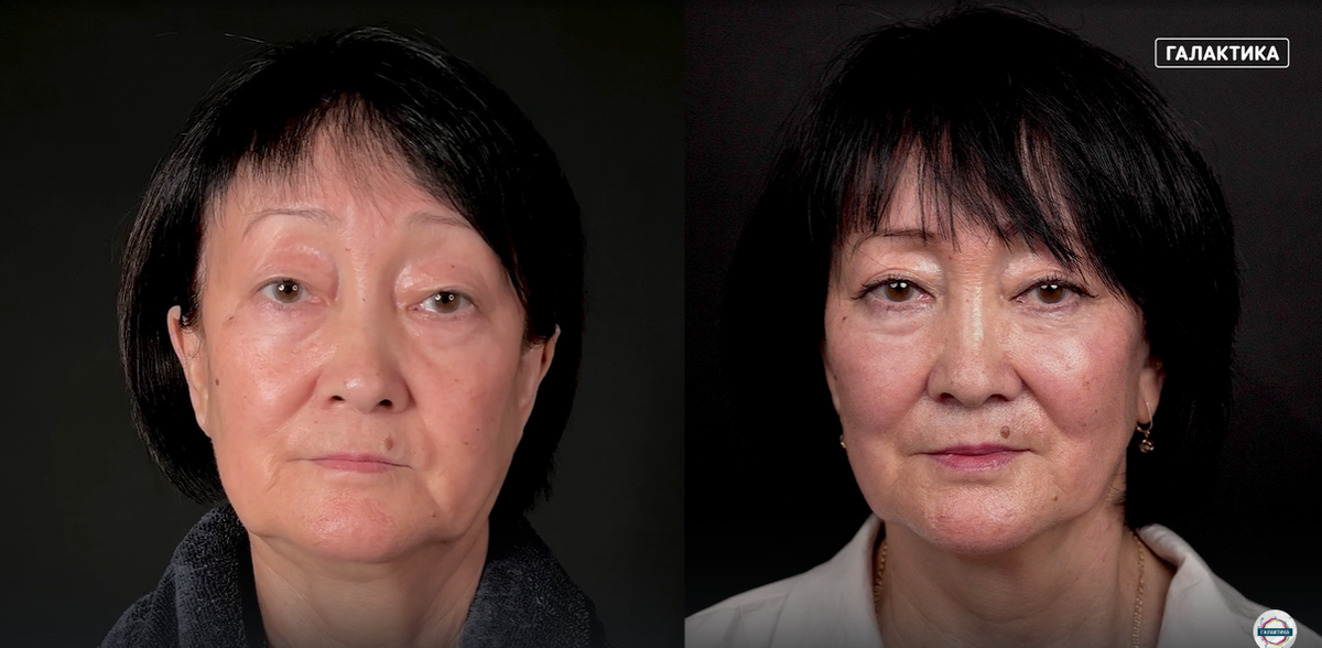 Пациентка Гульшара, до и после операции
