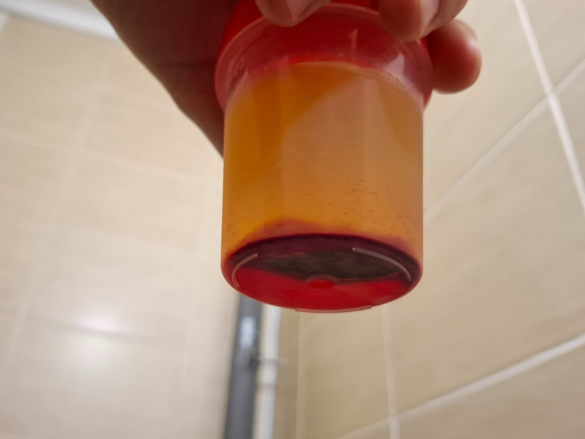 Асцитическая жидкость