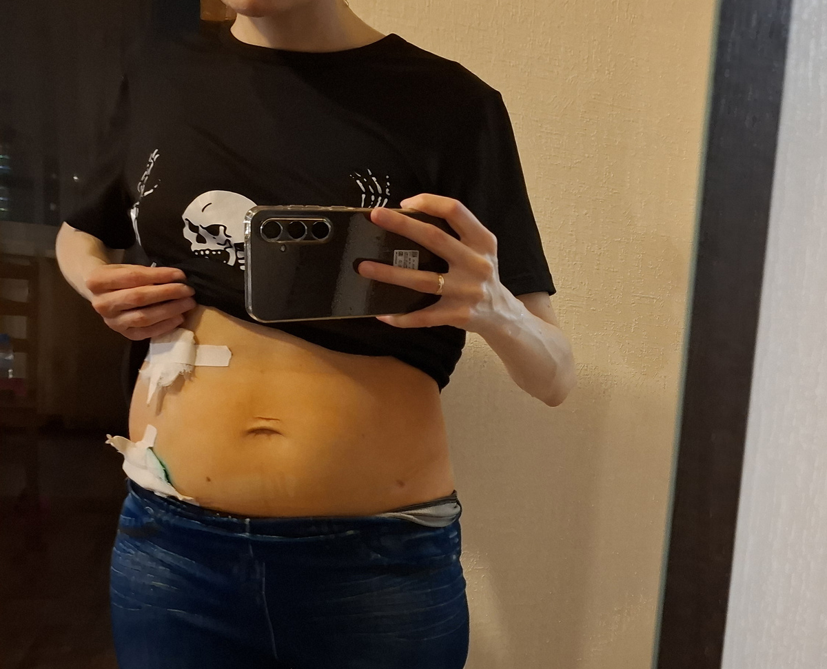 Живот через 10 дней после лапароскопии и лапароцентеза