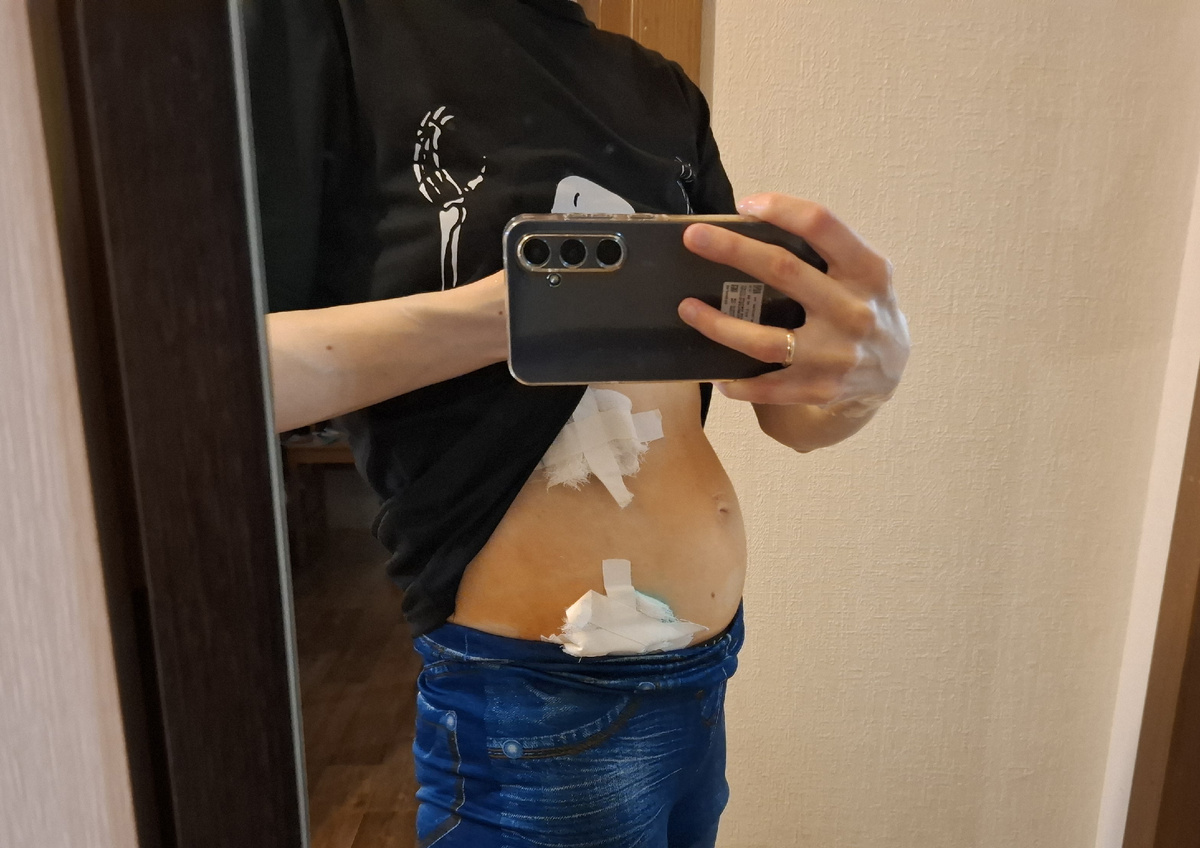 10 дней после операции