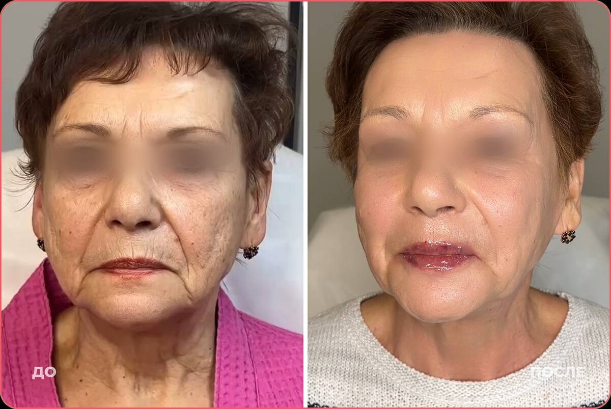 Процедура выполнена в кометллогии BALANCE 