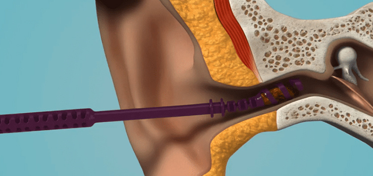 Серные пробки в ушах: тихая помеха, которую нельзя игнорировать