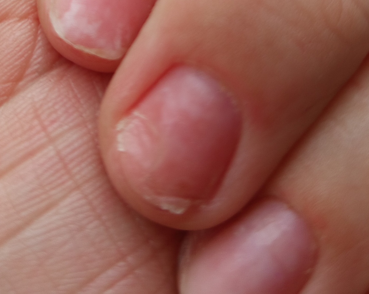 На фото уже защищённый онихолизис.