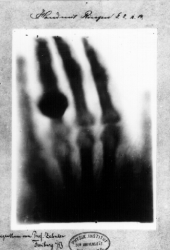 «Рука с кольцами» – первый в мире «медицинский» рентгеновский снимок. Рука Анны Берты Людвиг. 22 декабря 1895 года