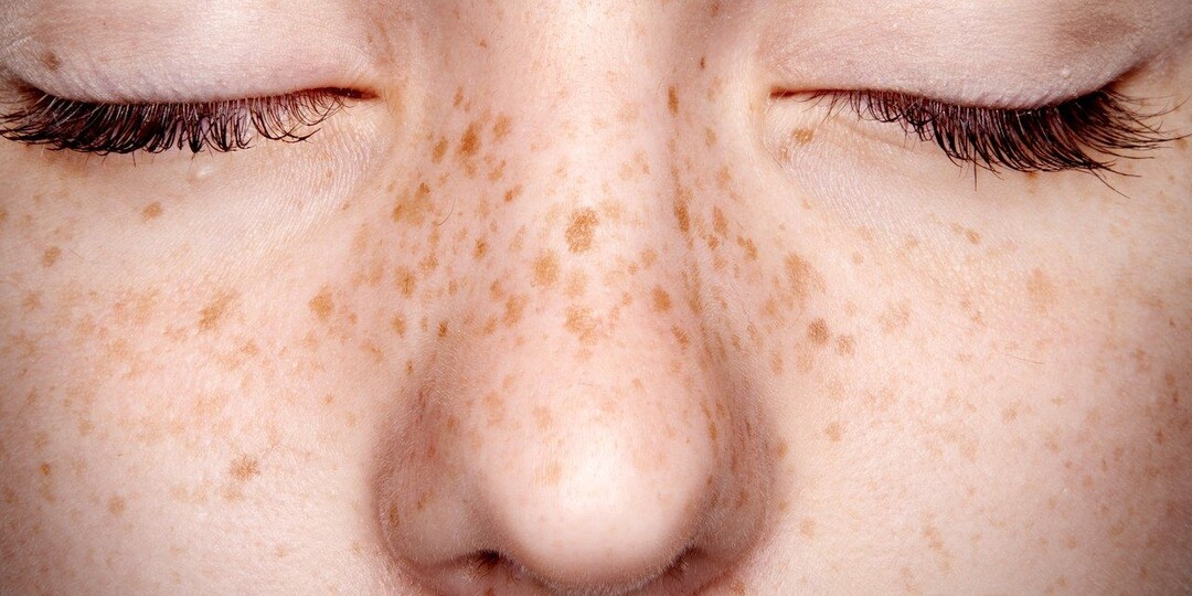 Пигментные пятна: почему они появляются и как с ними справиться — без паники, без дорогих процедур, просто и понятно