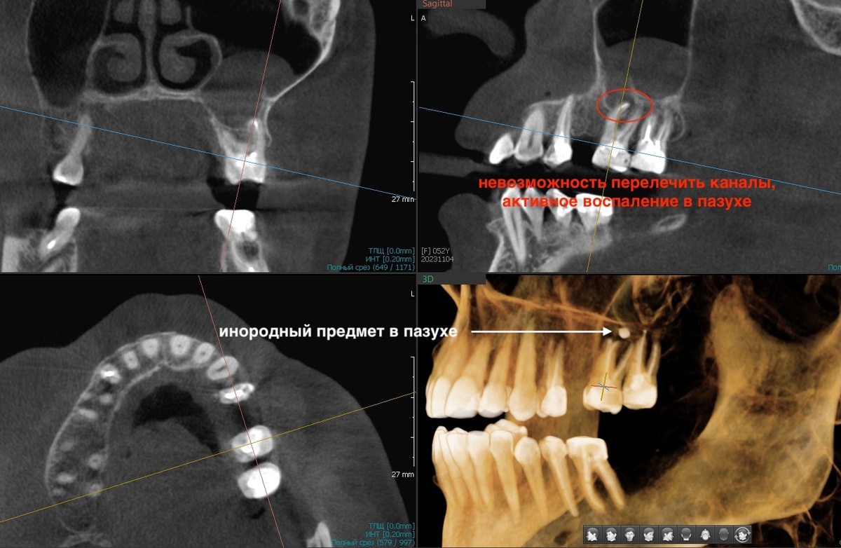 2.6 - пазуха не чиста, заполнена чем-то наполовину