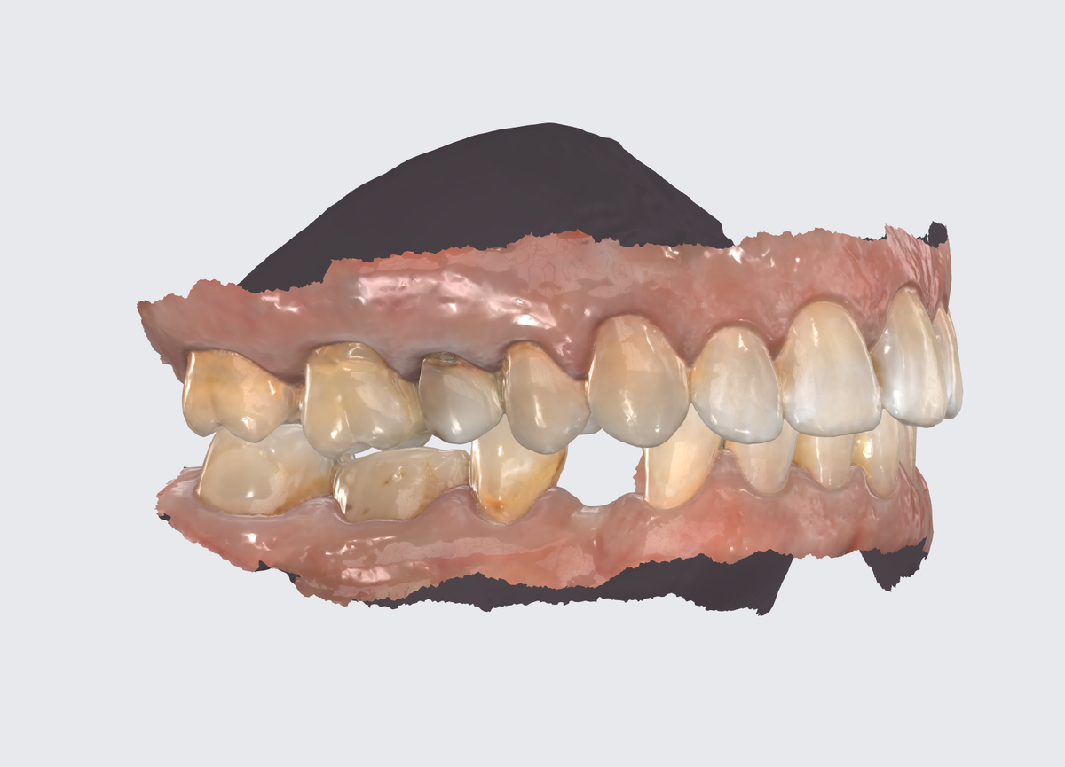 Зубы до - цифровой слепок