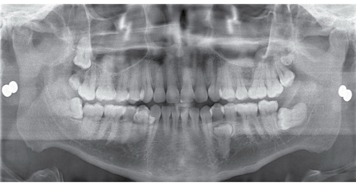 Панорамный снимок (OP 3D Pro) демонстрирует целый ряд сверхкомплектных и ретенированных зубов.