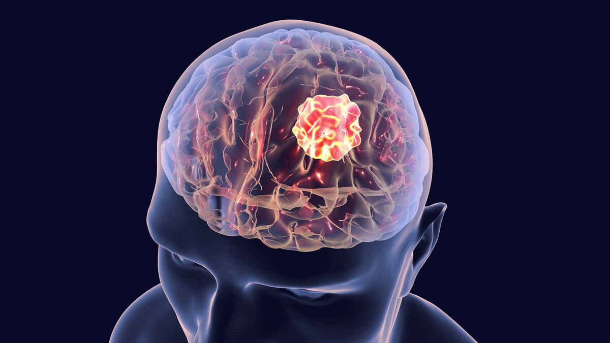 Когда головокружение связано не с сосудами, а с опухолью