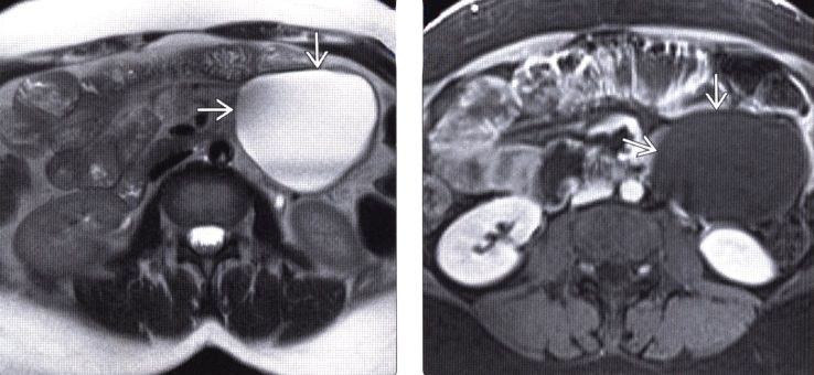 Так может выглядеть забрюшинная лимфангиома ( фото взято в сети Интернет)