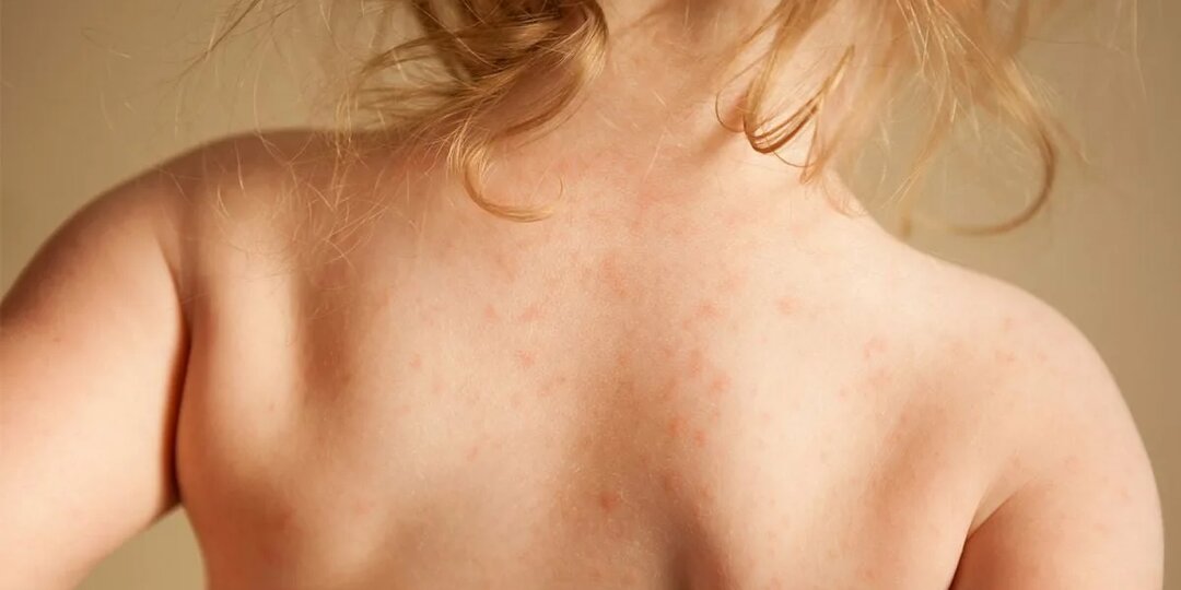 Вирусный лишай: что это, откуда берётся и как с ним жить