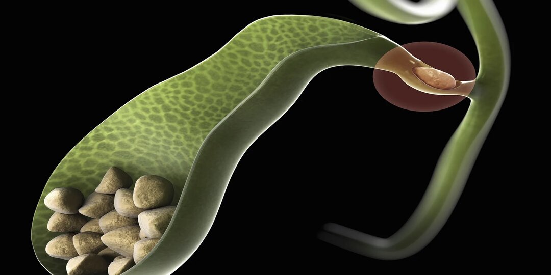 Желчные камни: не паникуйте — это решаемо!