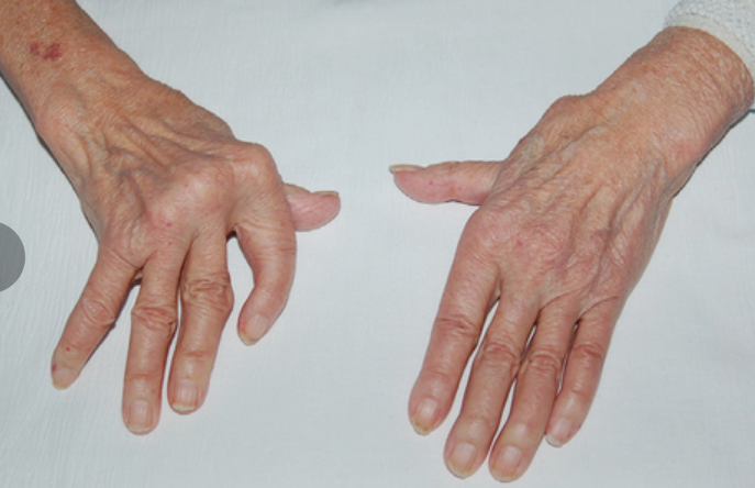 Псевдоподагра - название похоже, а болезнь - другая: что стоит о ней знать