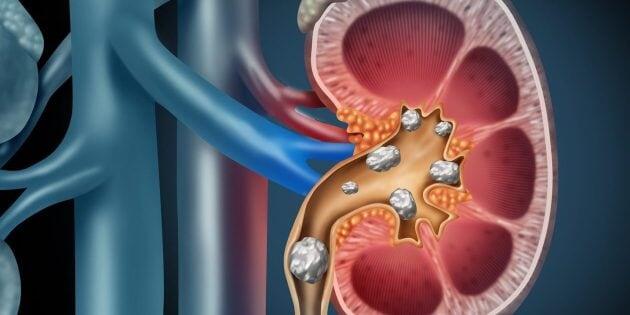 4 опасных популярных народных средства, которые точно не помогут от камней в почках