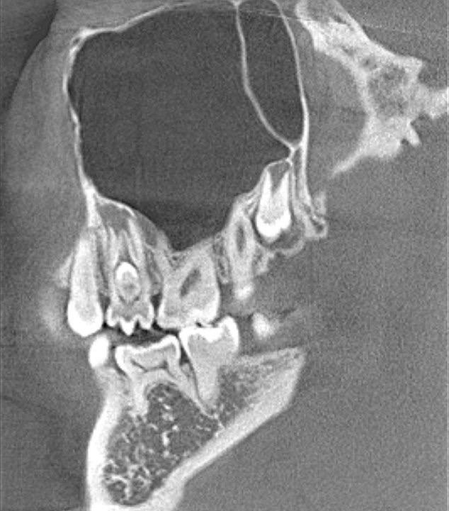 зуб в зубе - редкое аномальное строение зубов на КТ