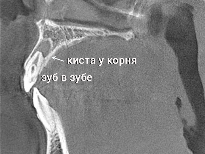 Лечение кисты у корня аномального по строению зуба