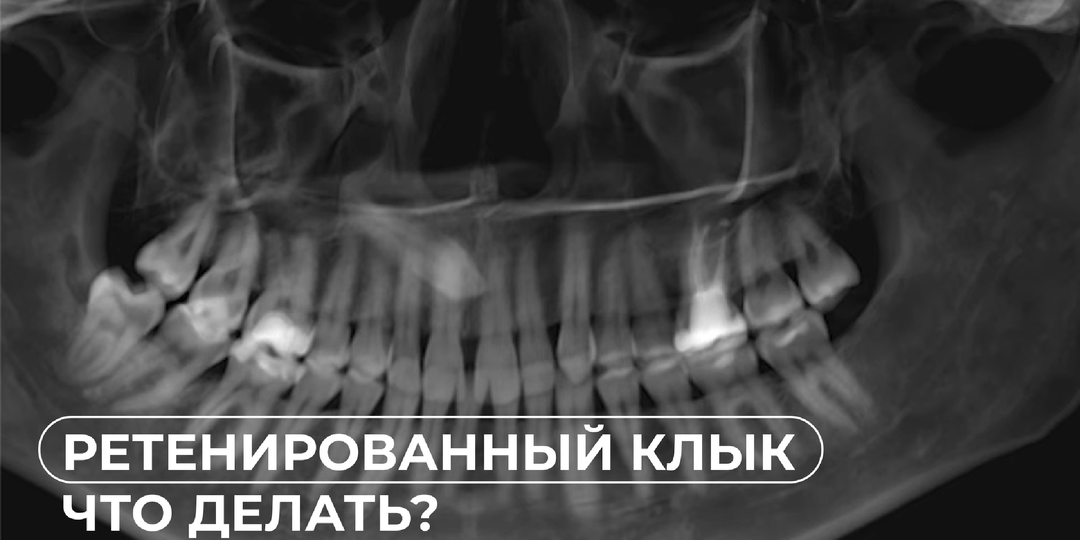 Ретенция клыка. Что делать?
