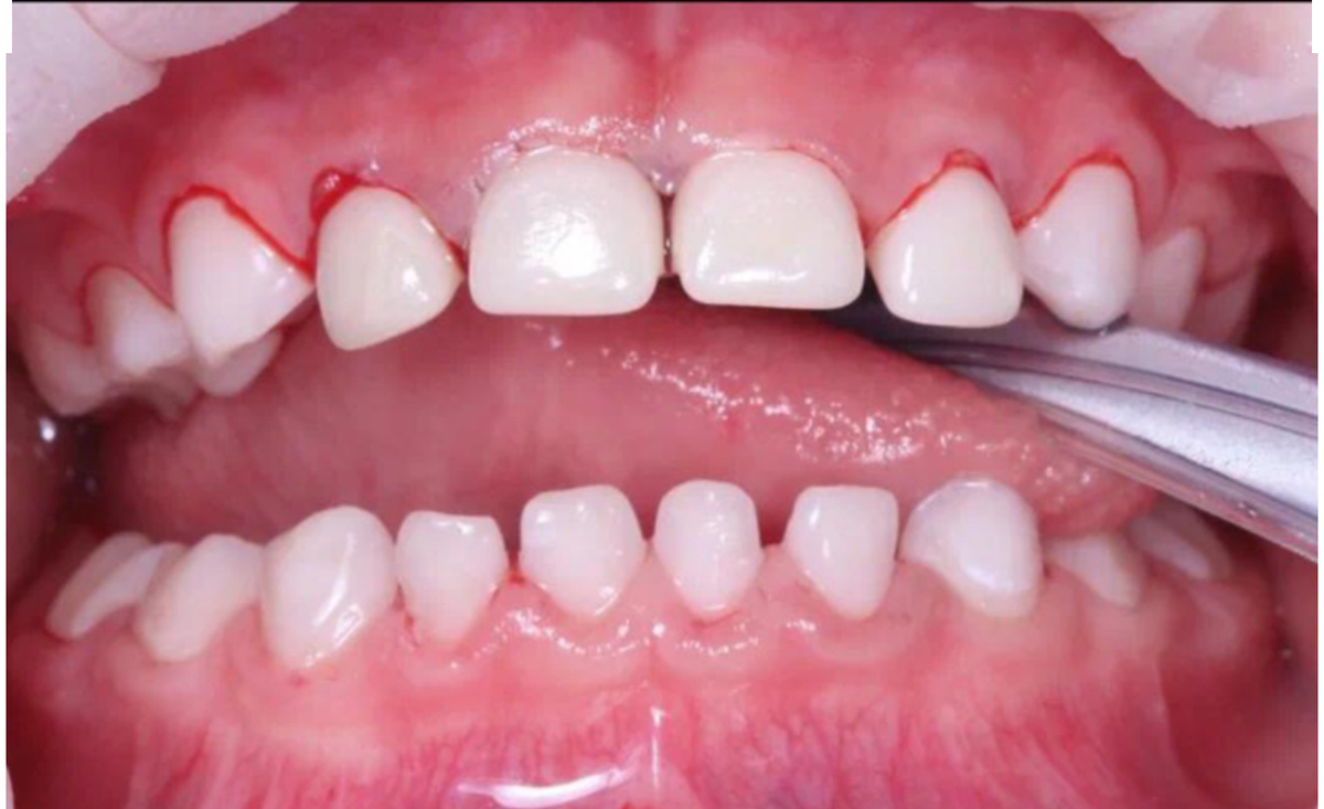 А была такая картина кариозных Зубов 