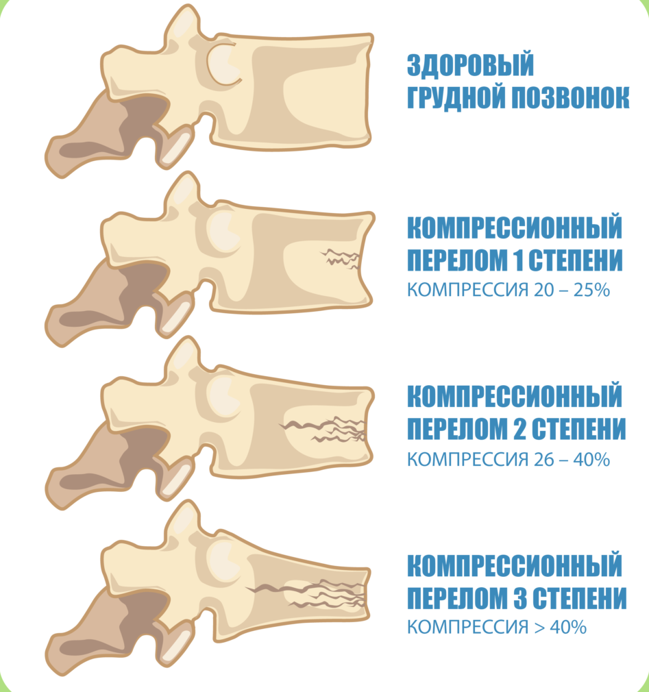 Степени компрессии позвонков.