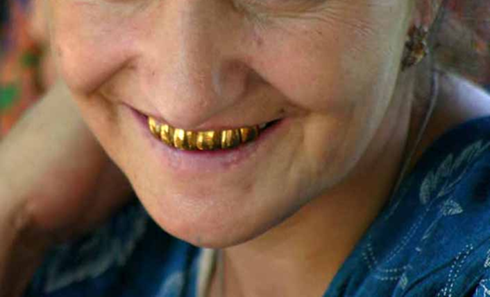 Золотые зубы – символ советского достатка, причем как у мужчин, так и у женщин. Это была одна из немногих возможностей выделиться. Однако золотые зубы требовали определённой коррекции: они быстро стачивались, поскольку золото чаще всего использовали мягкое, 850‑й пробы
