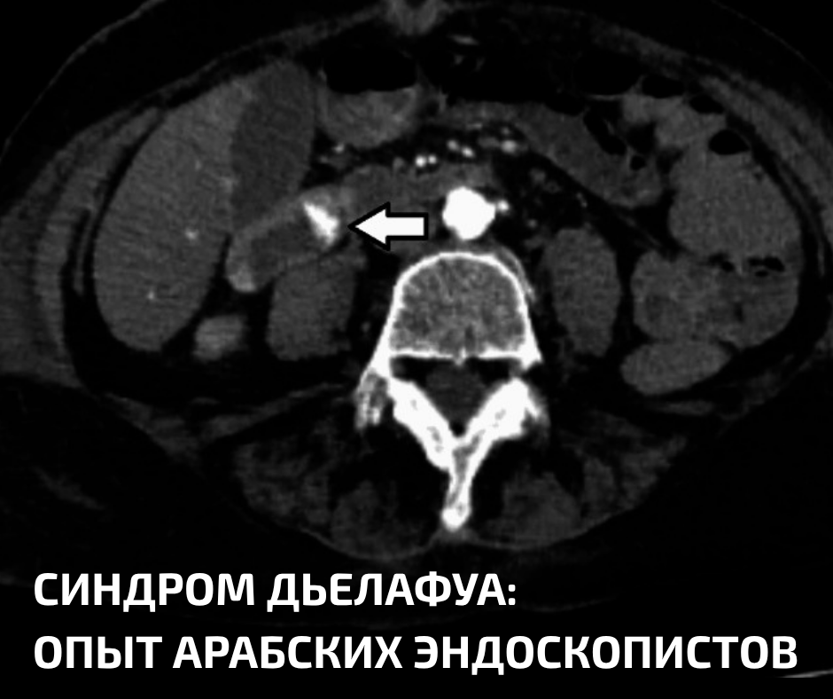 На КТ-ангиографии видна расширенная артерия: причина кровотечения при синддроме Дьелафуа. По материалам Alkhanjar et al.