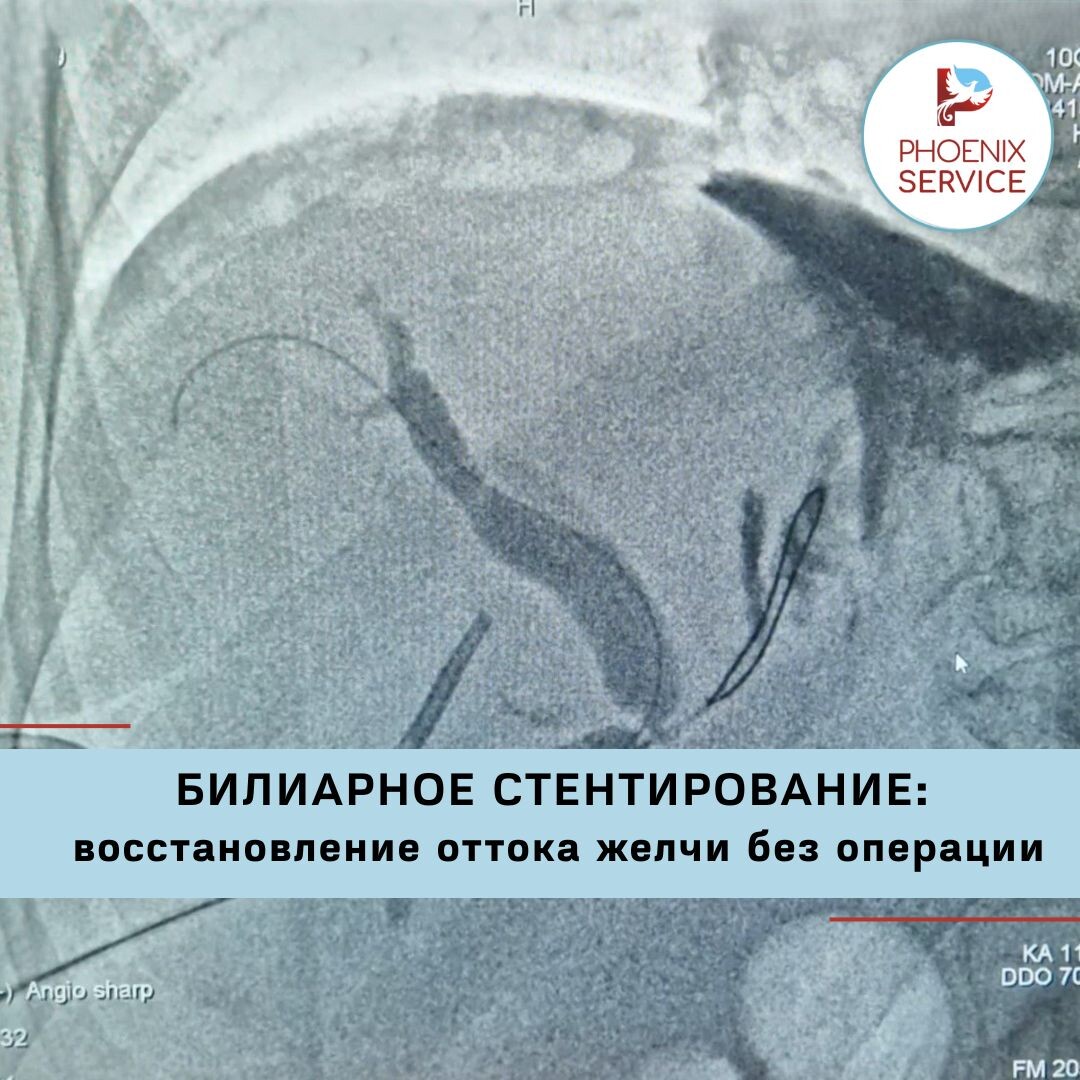 Процедура установки стента в желчные протоки для восстановления оттока желчи.