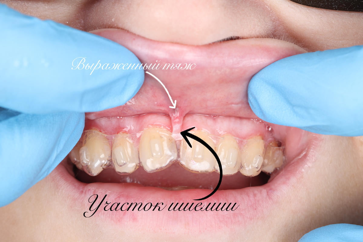Наше «До» Фото специально в элайнерах, чтобы наглядно показать участок травмирования межзубного сосочка 
