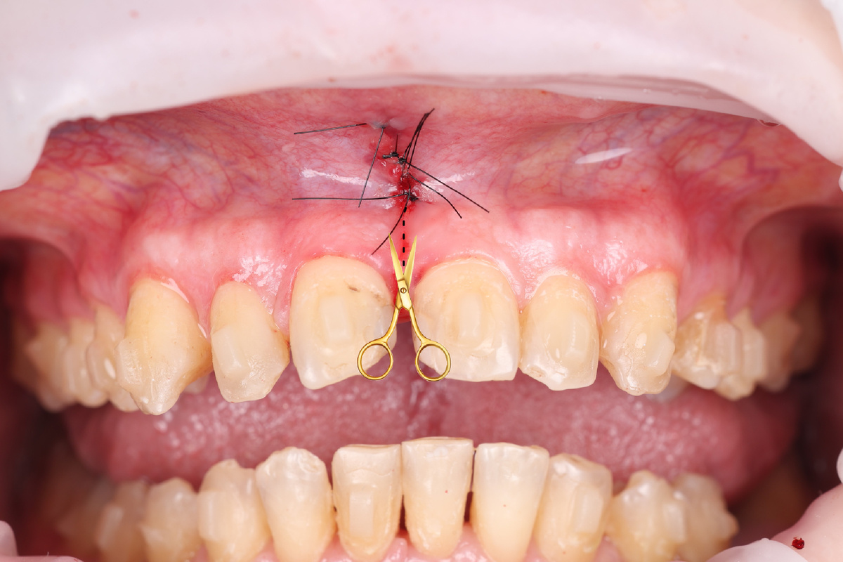 Сразу «После» Немного «бантиков» 