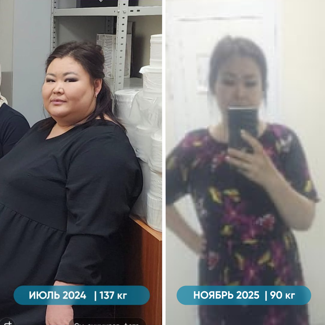 Похудела на 47 кг за 1 год и 3 месяца после продольной резекции желудка