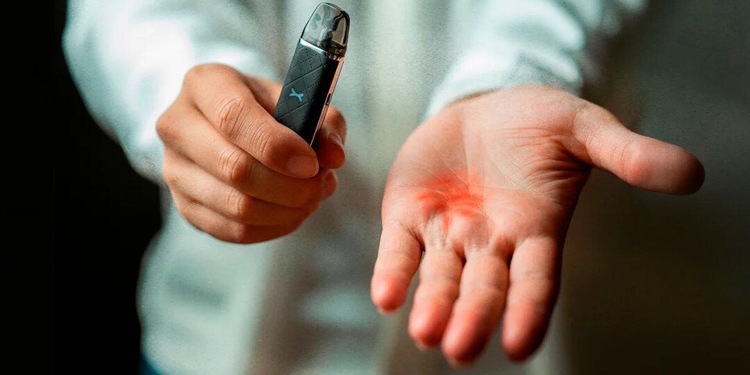 Аллергия на вейп: почему возникает и как её избежать