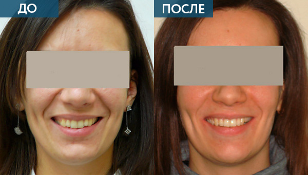 Исправление прикуса в Москве до и после лечения