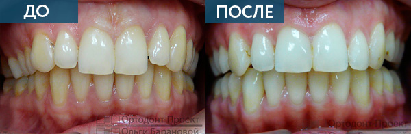 Исправление прикуса до и после